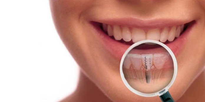 Jaki rodzaj implantów zębowych wybrać i czy należy obawiać się zabiegu?
