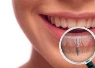 Jaki rodzaj implantów zębowych wybrać i czy należy obawiać się zabiegu?